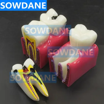 1pc Zubné Anatómie Vzdelávania Zuby Model 6-Krát Kazu Comparation Študijné Modely Vymeniteľné Zubov Zubný lekár Štúdium Štúdium